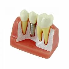 Dental Implants Treatment