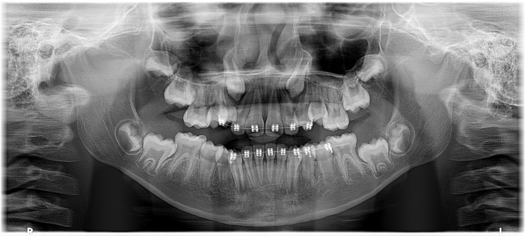 OPG & IOPA X-ray Imaging