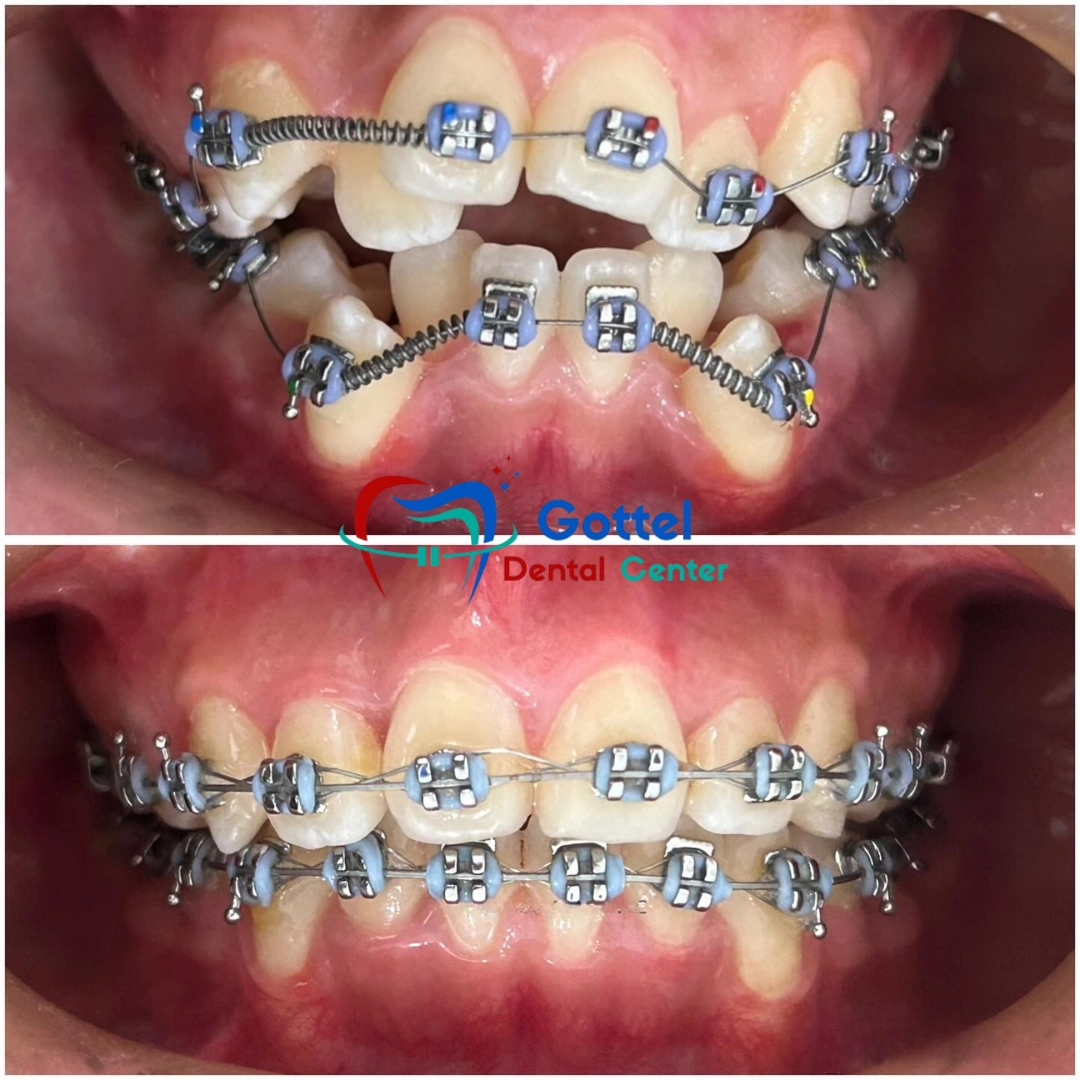 Orthodontic braces treatment progress