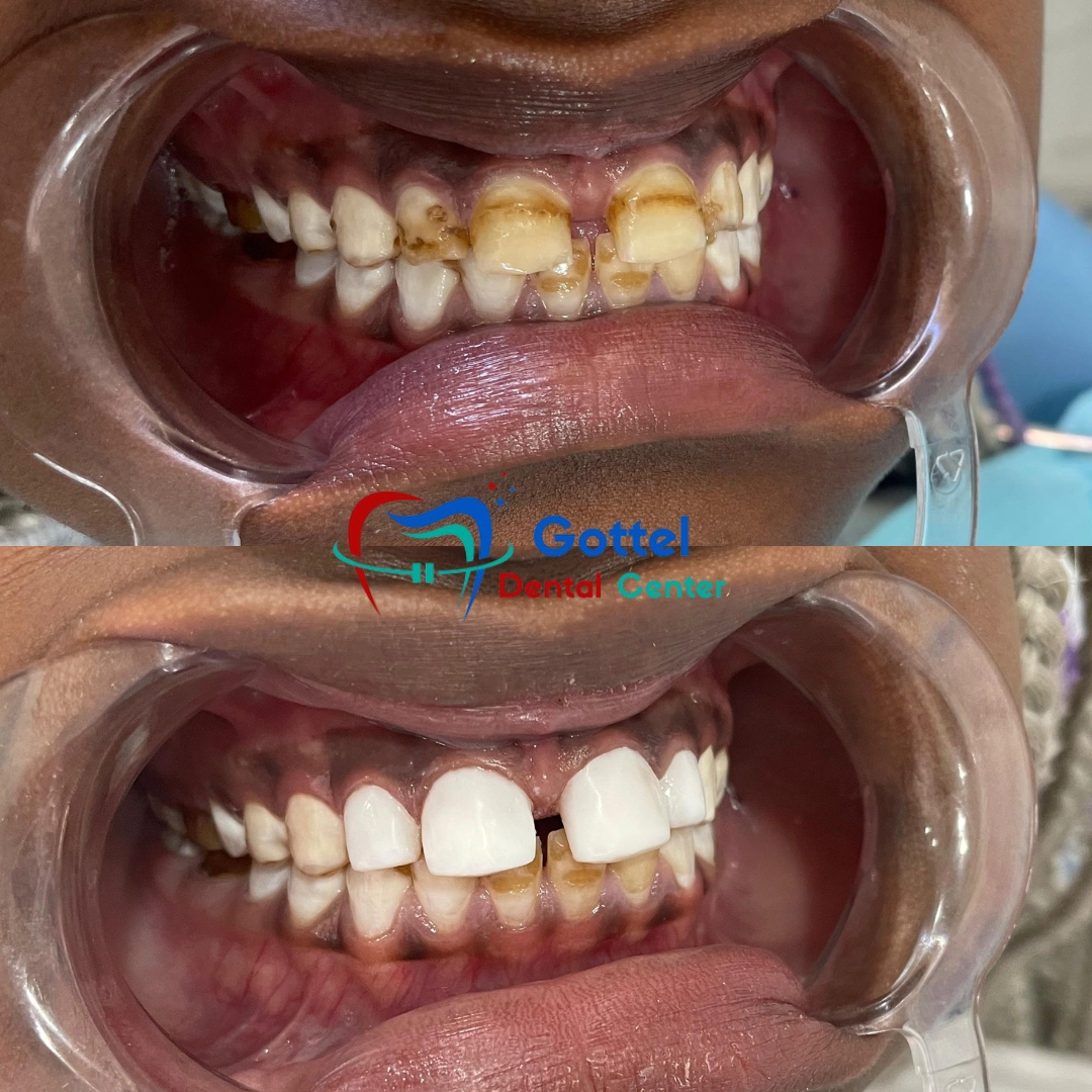 Dental restoration before and after
