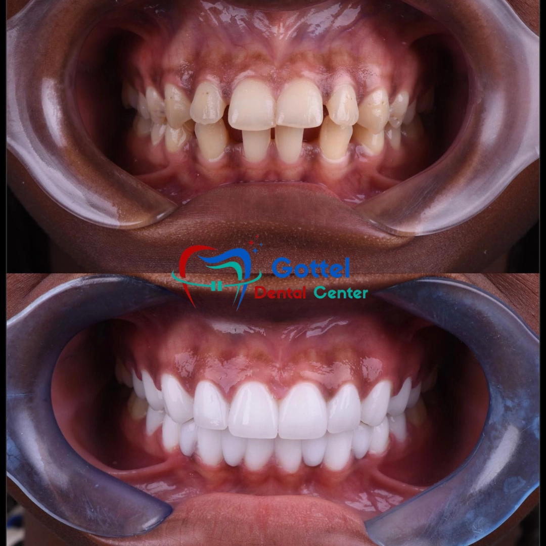 Orthodontic treatment before and after results