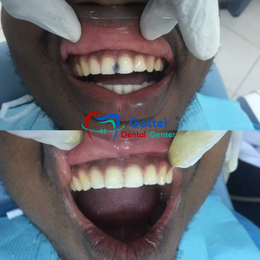 Professional dental cleaning and whitening