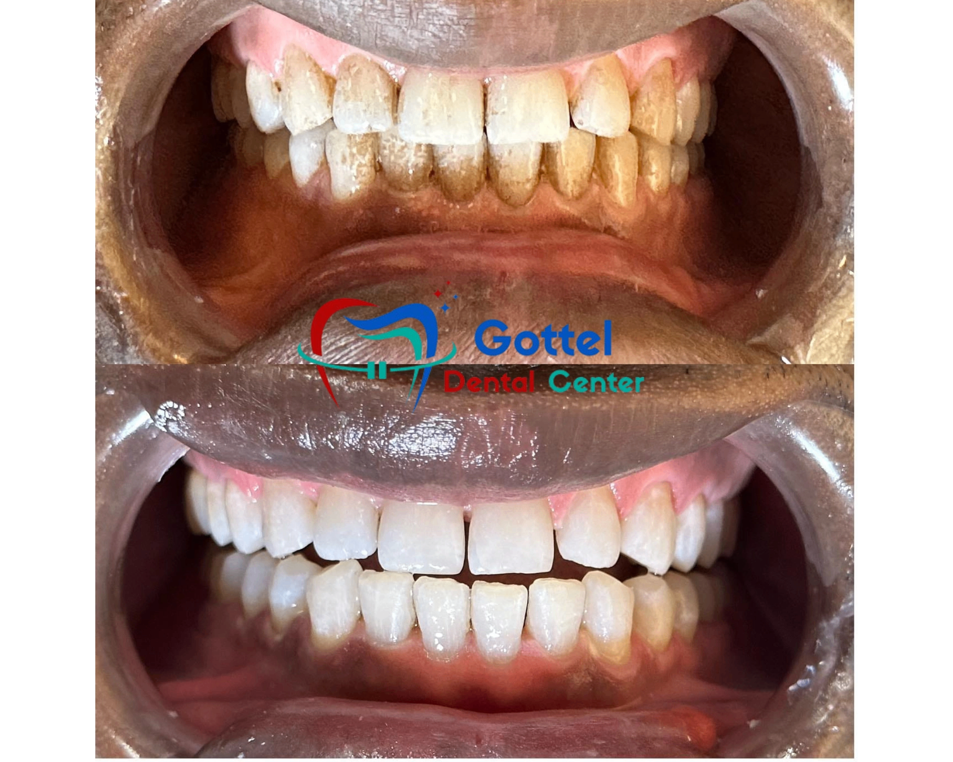 Complete smile makeover transformation